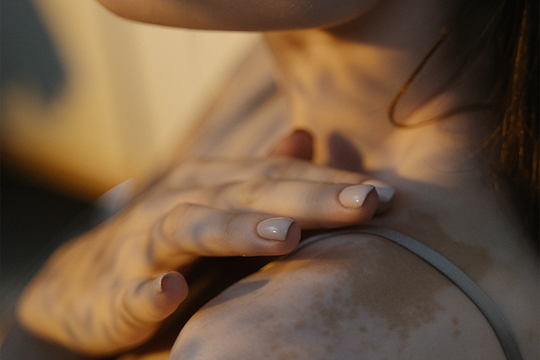 mujer con piel afectada por manchas blancas o despigmentación en la piel